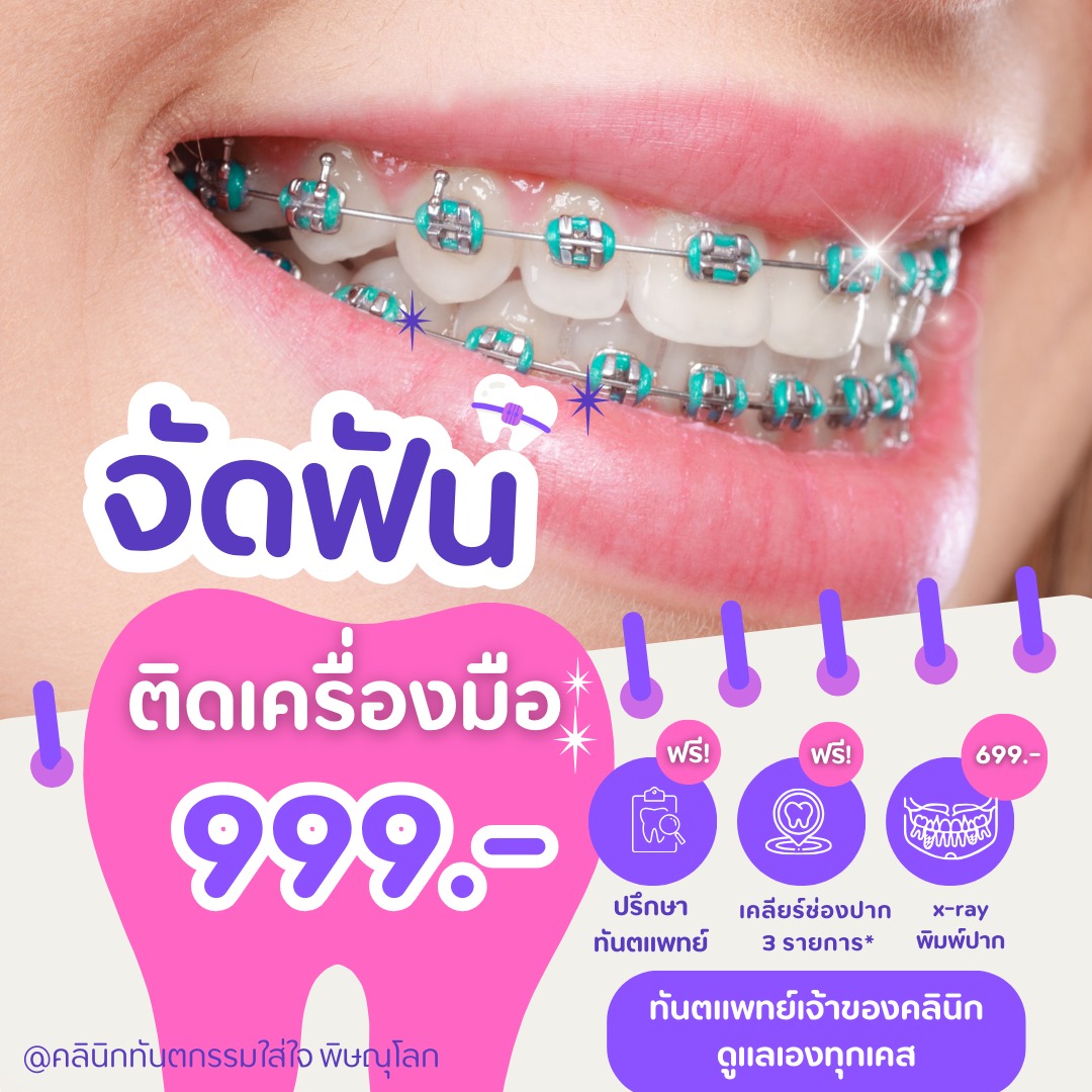 ฟันซ้อนเก ฟันยื่น ฟันห่าง ยิ้มแล้วไม่มั่นใจ?
👉 จัดฟันแก้ได้ มั่นใจทุกครั้งที่ยิ้ม

🔥 โปรโมชั่นพิเศษ! ติดเครื่องมือเริ่มต้นเพียง 999.-
⚡ จำกัดแค่ 20 เคสเท่านั้น รีบจองก่อนเต็ม!

ของแถมจัดเต็ม
📍 พิมพ์ปาก + ถ่ายรูป + X-ray 2 ฟิล์ม เพียง 699.- (ปกติ 2,000)
📍 สิทธิ์บัตรทอง เคลียร์ช่องปากฟรี 3 รายการ
📍 สิทธิ์ประกันสังคม ไม่ต้องสำรองจ่ายในวงเงิน 900.-
✅ ฟรี! ติดเครื่องมือหลุดตลอดการจัด (นำแบคเก็ตเก่ากลับมา)
✅ ฟรี! ถอดเครื่องมือเมื่อจัดฟันเสร็จ (ปกติ 2,000)

แพ็กเกจโปรสุดคุ้ม
❤️ โปร 1

ติดเครื่องมือบน 999

ติดเครื่องมือล่าง 999

ปรับเครื่องมือ 1,500 × 4 เดือน

เดือนต่อไป 1,000

❤️❤️ โปร 2

ติดเครื่องมือบน+ล่าง 2,500

ปรับเครื่องมือ 2,500 × 2 เดือน

เดือนต่อไป 900

*ค่าใช้จ่ายตามระยะเวลาการจัดฟัน
*รีเทนเนอร์หลังจัดฟันเสร็จ 3,000 บาท

#จัดฟันพิษณุโลก #โปรจัดฟัน #คลินิกทันตกรรมพิษณุโลก #จัดฟันใกล้ฉัน #จัดฟันเปลี่ยนชีวิต