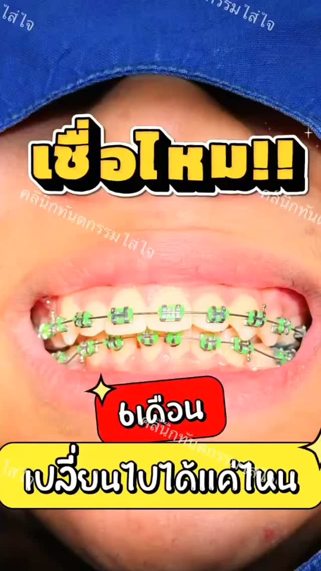 จากคนไม่กล้ายิ้ม ตอนนี้ยิ้มโชว์เหล็กแบบมั่นใจใน 6 เดือน🥰😁
#คลินิกทำฟัน #ทำฟันพิษณุโลก #ทันตกรรมใส่ใจ #รับสิทธิ์บัตรทอง #ทำฟันฟรี ประกันสังคมไม่ต้องสำรองจ่าย ทำฟันจัดฟัน