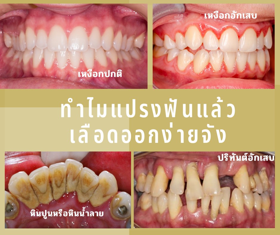 แปรงฟันแล้วมีเลือดออก มีกลิ่นปาก เหงือกบวม!!!!!
สัญญาณแบบนี้ไม่ควรละเลย🚫
 เพราะส่วนใหญ่เกิดจาก “เหงือกอักเสบ” จากคราบจุลินทรีย์และหินน้ำลายที่สะสมอยู่ 
ถ้าปล่อยไว้นาน ๆ อาจลามเป็น “ปริทันต์อักเสบ” จนฟันโยกได้เลยค่ะ
แนะนำ💥💫
✔️ ตรวจฟัน ขูดหินน้ำลาย ทุก 6 เดือน
✔️ แปรงฟัน + ทำความสะอาดซอกฟันสม่ำเสมอ📍

#เหงือกอักเสบ #แปรงฟันแล้วเลือดออก #ขูดหินปูน #คลินิกทันตกรรมพิษณุโลก #โรคเหงือก #คลินิกทันตกรรมใกล้ฉัน #ทำฟันฟรี