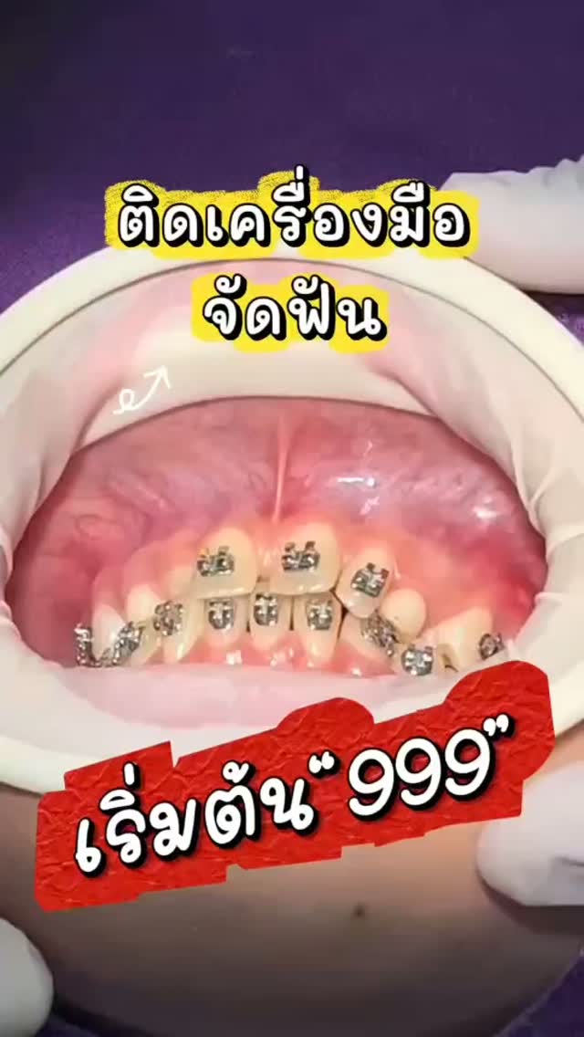 🦷 โปรจัดฟัน เริ่มต้นเพียง 999 บาท ✨
อยากมีรอยยิ้มที่มั่นใจ เริ่มต้นได้ง่ายกว่าที่คิด!

✅ ตรวจและปรึกษาทันตแพทย์ ฟรี!
✅ มีโปรโมชั่นติดเครื่องมือ ราคาสุดคุ้ม
✅ ผ่อนชำระได้ ช่วยแบ่งเบาค่าใช้จ่าย
✅ ดูแลและติดตามผลตลอดการจัดฟันโดยทันตแพทย์
✅ สิทธิ์บัตรทองสามารถใช้เคลียร์ช่องปากได้ฟรี 3 รายการ ‼️

📌 เปิดรับจำนวนจำกัด รีบจองคิวก่อนเต็ม!
📩 สอบถามรายละเอียดเพิ่มเติม หรือจองคิวผ่านแชทได้เลย